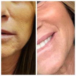 California Cryo - Process of Skin Boosters and Collagen, our Collagen