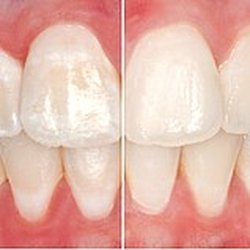 Broadway Smile Designers - ICON treatment for discoloration teeth