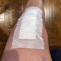Vance Eberly, MD - Post operation nano knee procedure
