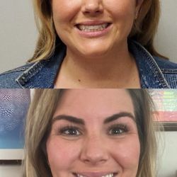 Sloan's Lake Dental - TMJ treatment before (top pic) and after (bottom pic)