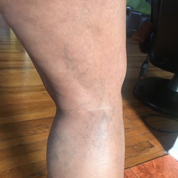 USA Vein Clinics - Vascular Medicine Near Me - Valley Stream, New York USA Vein Clinics - Vascular Medicine Near Me - Valley Stream, New York