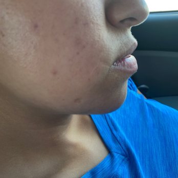 Bodi Louisville - When I came in my acne was way less and am all Bruce because of what they did. Be very careful they are a SCAM!!!! - Medical Spas Near Me - Louisville, Kentucky