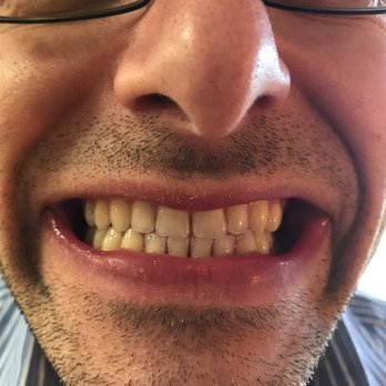 Eyvazi Dental - Erik Pic 3 (after) - Orthodontists Near Me - Hawthorne, California Eyvazi Dental - Erik Pic 3 (after) - Orthodontists Near Me - Hawthorne, California