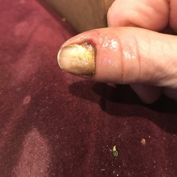 Anna Nails & Spa - Bloody cuticle with neosporin and most of painted-over powder and polish gone. - Nail Salons Near Me - Washington, DC, District of Columbia Anna Nails & Spa - Bloody cuticle with neosporin and most of painted-over powder and polish gone. - Nail Salons Near Me - Washington, DC, District of Columbia