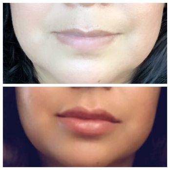Plush Derma - Before / after my 2 week follow up - Medical Spas Near Me - Huntington Park, California Plush Derma - Before / after my 2 week follow up - Medical Spas Near Me - Huntington Park, California