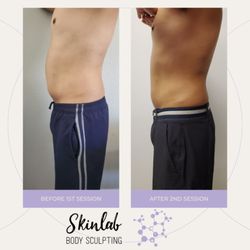 SkinLab Aesthetics - Cavitation