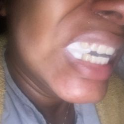 Academy Dental - I went for veneers to fix my smile and left with less that I came with. I was Deceived multiple times about the procedure and cost.
