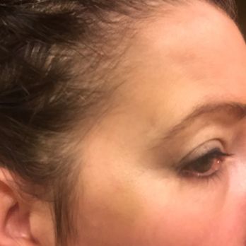 Nu U Laser Centers - After photos... 9 days later.. way worse - Medical Spas Near Me - Beaverton, Oregon Nu U Laser Centers - After photos... 9 days later.. way worse - Medical Spas Near Me - Beaverton, Oregon