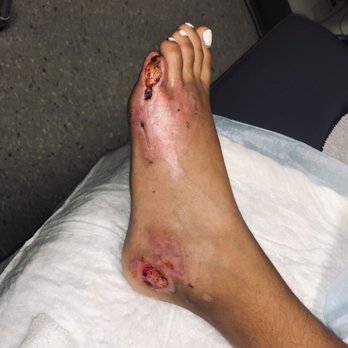 Andre Panossian, MD - After he did one time debridement! 10 days after - Cosmetic Surgeons Near Me - Pasadena, California Andre Panossian, MD - After he did one time debridement! 10 days after - Cosmetic Surgeons Near Me - Pasadena, California