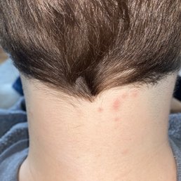 Bites in a line along my hairline