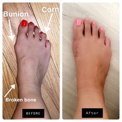 Fremont Podiatrists Group - Before and After foot surgery
