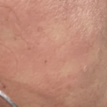 LaserAway - You can clearly see the squares leaving parts of my face untreated - Laser Hair Removal Near Me - San Carlos, California