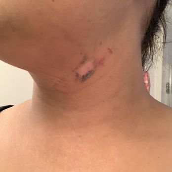 Hudes Laser Aesthetica - Burn from wrong laser used - Laser Hair Removal Near Me - Cumming, Georgia Hudes Laser Aesthetica - Burn from wrong laser used - Laser Hair Removal Near Me - Cumming, Georgia