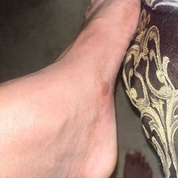 United Skates of America - Blister on left foot
