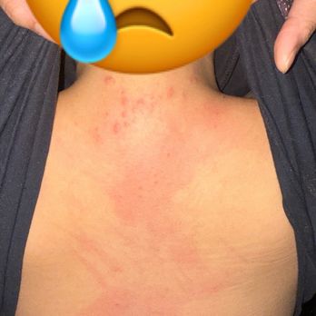Urban Residences Rotterdam - Bed bugs after half a night's rest, discovered as we were being evicted. - Vacation Rentals Near Me - Rotterdam, ZH