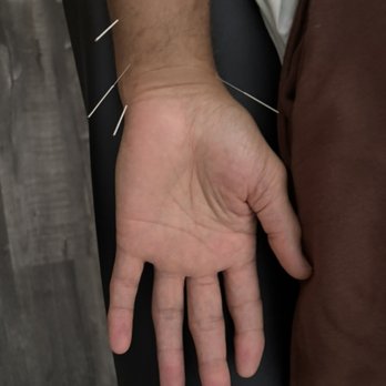 Vital Source Acupuncture - Patient came in with wrist pain from boxing - Acupuncture Near Me - Torrance, California Vital Source Acupuncture - Patient came in with wrist pain from boxing - Acupuncture Near Me - Torrance, California