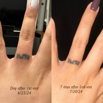 LaserXX - No results at all whatsoever after 2nd session - Tattoo Removal Near Me - Los Angeles, California LaserXX - No results at all whatsoever after 2nd session - Tattoo Removal Near Me - Los Angeles, California