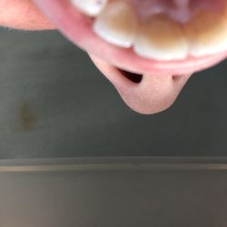Treacy Jones DDS - The tooth in the center was completely black I. The back when I first went in.