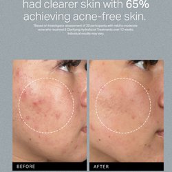 Aesthetic OOGII - ACNE BEFORE AND AFTER