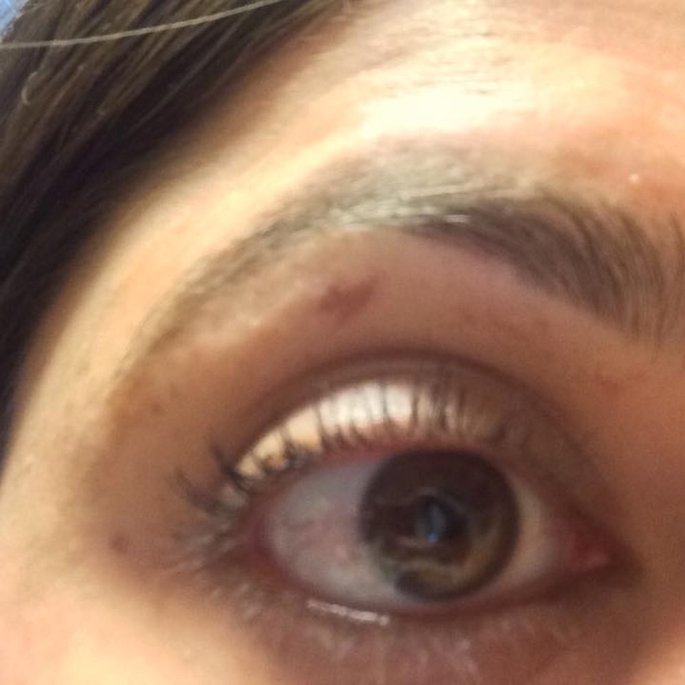Bruised eye after the brow waxing- this is the third day since I got it. Bruised eye after the brow waxing- this is the third day since I got it.