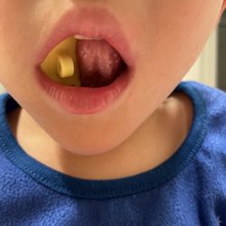 RM Studio Speech Therapy Services - Working with bite block and tongue strengthening and positioning