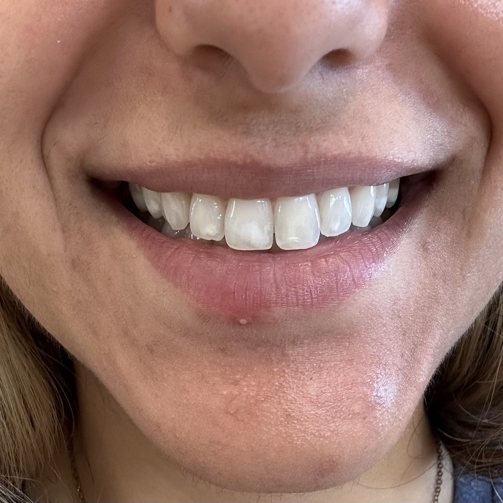 Peak Dental Specialists - Chipped tooth after - Periodontists Near Me - Glendora, California Peak Dental Specialists - Chipped tooth after - Periodontists Near Me - Glendora, California