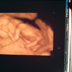 Baby's First Ultrasound - My baby at 15 weeks