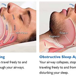 The Columbus Sleep Center - Normal airway and an obstructive airway.