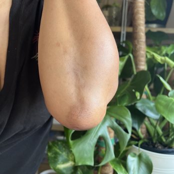 Vglow Beauty Bar - Atopic Dermatitis Improvement progression with Glutha-push - Skin Care Near Me - Costa Mesa, California Vglow Beauty Bar - Atopic Dermatitis Improvement progression with Glutha-push - Skin Care Near Me - Costa Mesa, California
