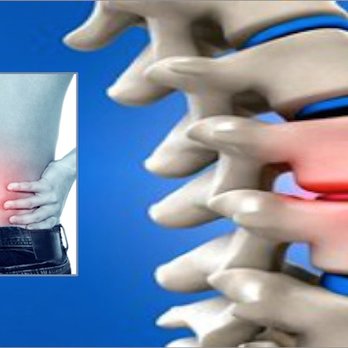 Chiropractic Healing Center - Slipped disc - Chiropractors Near Me - Woodstock, Georgia Chiropractic Healing Center - Slipped disc - Chiropractors Near Me - Woodstock, Georgia