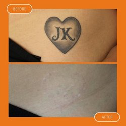 Delete Tattoo Removal and Medical Salon