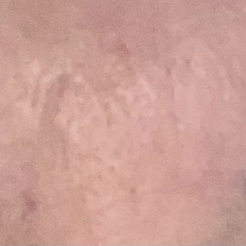 Ronald M. Warren, MD FACS - Not even 24 hours later, and my "11's" are almost non-existent!!! (2/4/23) - Cosmetic Surgeons Near Me - Marlton, New Jersey Ronald M. Warren, MD FACS - Not even 24 hours later, and my "11's" are almost non-existent!!! (2/4/23) - Cosmetic Surgeons Near Me - Marlton, New Jersey