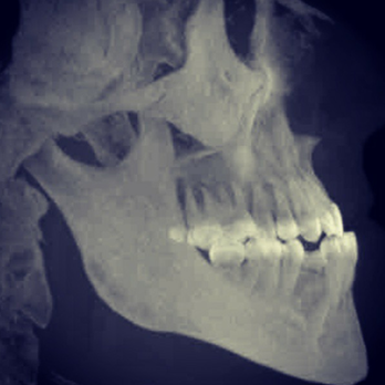 Dr. Gray Orthodontic Specialists - Pre braces underbite - Orthodontists Near Me - Upland, California Dr. Gray Orthodontic Specialists - Pre braces underbite - Orthodontists Near Me - Upland, California