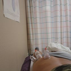 Chinese Acupuncture and Herb - Cupping after acupuncture