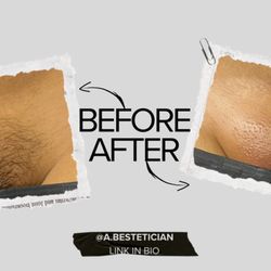 A Bestetician - Before and After of a Brazilian Wax