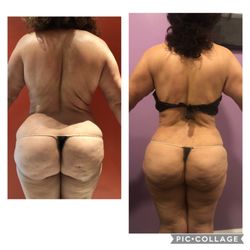 Lotus Body Contouring & Post-Lipo Aftercare - Before and after Body Contouring