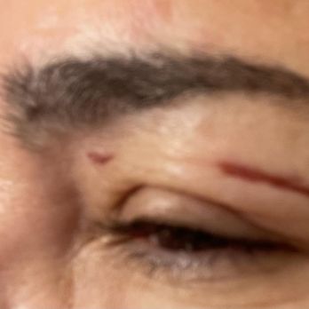 Euro Nails & Spa - EYEBROW WAX BURNS BY EURO NAILS & SPA, POINCIANA, FL - Nail Salons Near Me - Kissimmee, Florida