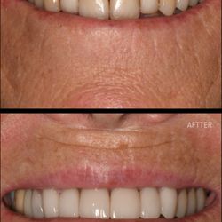Harmony Dentistry - Before and after crown makeover done by Dr. Ash