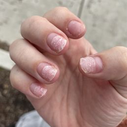 Nail damage Nail damage