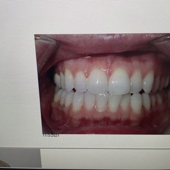 TLC for Smiles - Chatsworth - Before and After - Orthodontists Near Me - Chatsworth, California TLC for Smiles - Chatsworth - Before and After - Orthodontists Near Me - Chatsworth, California