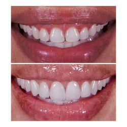 Pearl Dental Group - Perkins Rd - Porcelain Veneers