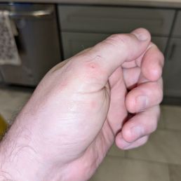 The puncture in my thumb from the cat The puncture in my thumb from the cat