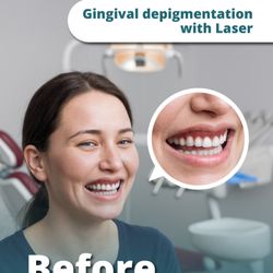 Sense Dental Center - Gingival depigmentation with laser