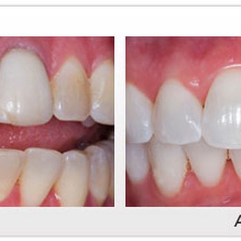 Ellen Denise Malcomson, DDS - Malcomson Dentistry - Malcomson Dentistry offers a teeth whitening program to patients. - General Dentistry Near Me - Bethesda, Maryland Ellen Denise Malcomson, DDS - Malcomson Dentistry - Malcomson Dentistry offers a teeth whitening program to patients. - General Dentistry Near Me - Bethesda, Maryland