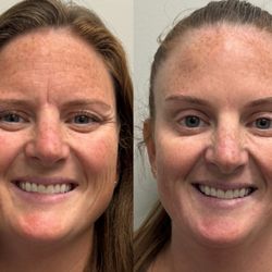 Lifted Aesthetics Charlotte - Botox Dysport Xeomin Letybo