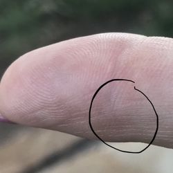 AM PM Doctors Urgent Care Clinic - Finger with area designated that needed orthopedic surgeon consult???
