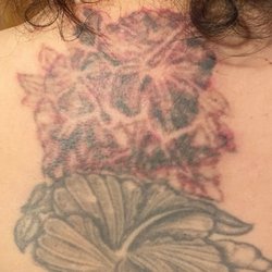 Oops! Laser Tattoo Removal - After my third session