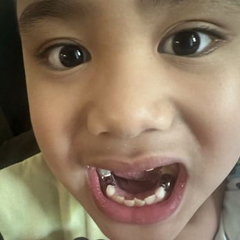 ChildSmiles OC Pediatric Dentistry - Dr Mehdi did his work so perfectly! - Pediatric Dentists Near Me - Fullerton, California
