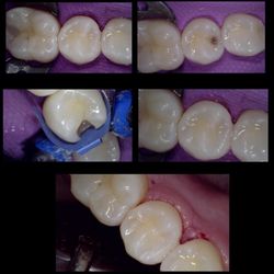 JD Ross, DDS - Another example of how important it is to have routine dental health check ups! This patient had no idea that their teeth were being destroy
