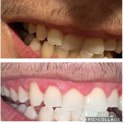 Jay’s Teeth Whitening